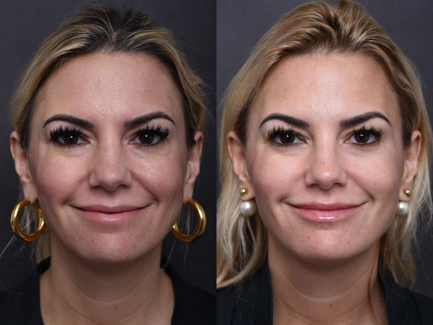 Austin Injectable Fillers Before & After Gallery - Patient 219526 - Image 2 - The Piazza Center