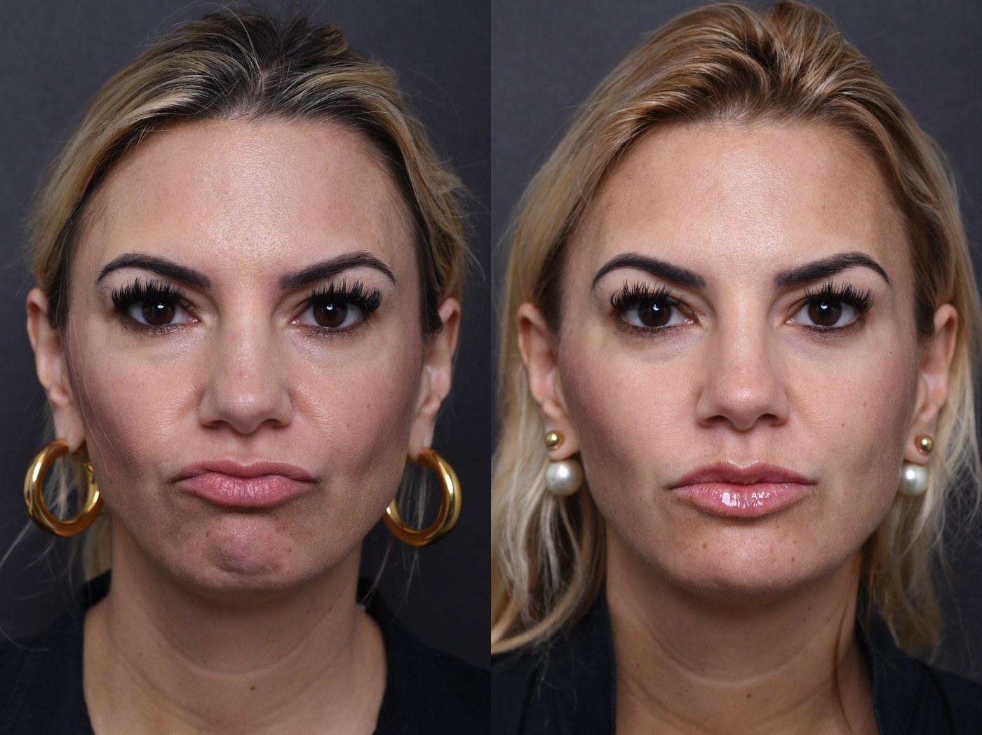 Austin Injectable Fillers Before & After Gallery - Patient 219526 - Image 3 - The Piazza Center