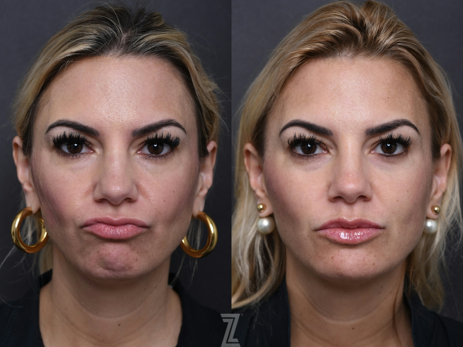 Austin Injectable Fillers Before & After Gallery - Patient 219526 - Image 3 - The Piazza Center