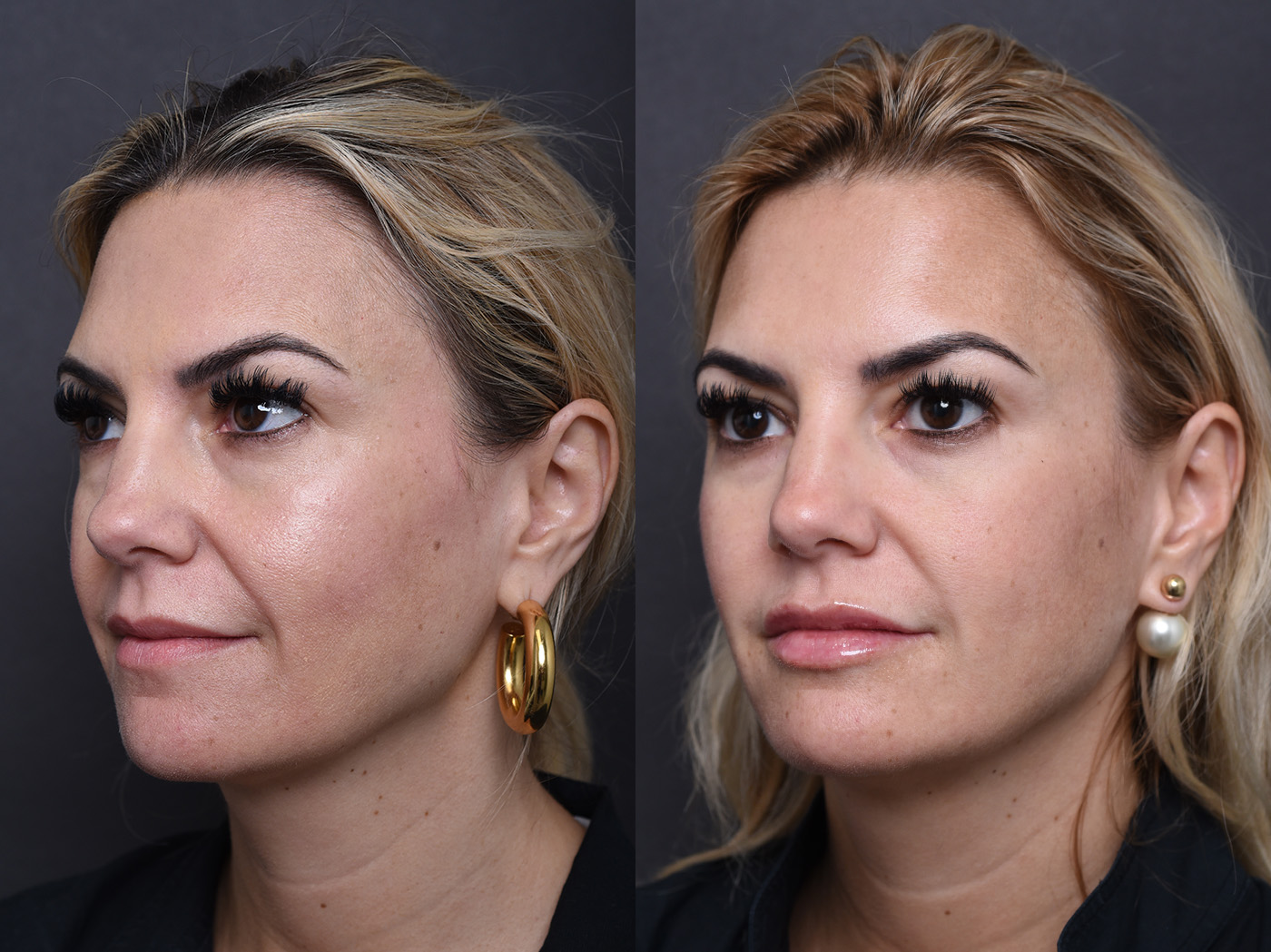 Austin Injectable Fillers Before & After Gallery - Patient 219526 - Image 1 - The Piazza Center