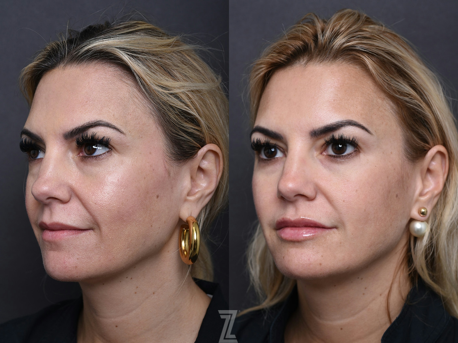 Austin Injectable Fillers Before & After Gallery - Patient 219526 - Image 1 - The Piazza Center