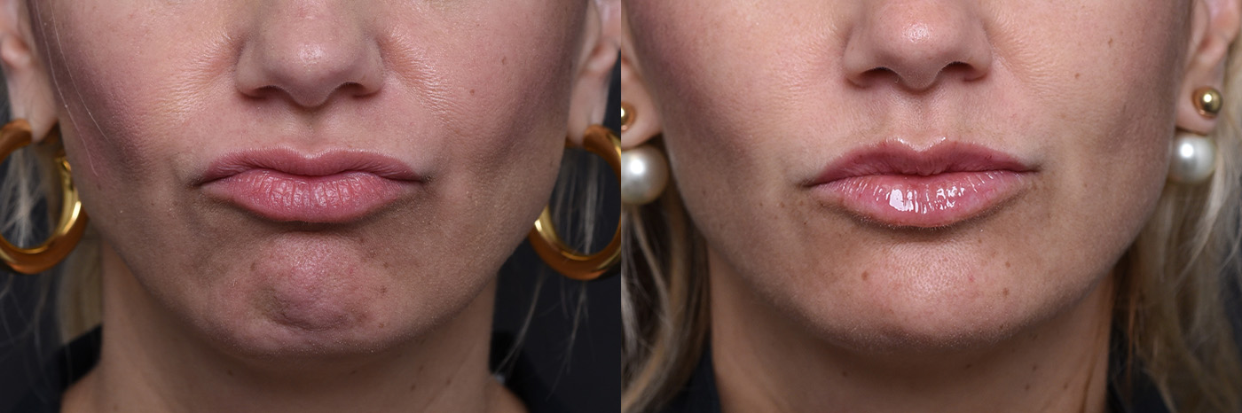 Austin Injectable Fillers Before & After Gallery - Patient 219526 - Image 6 - The Piazza Center