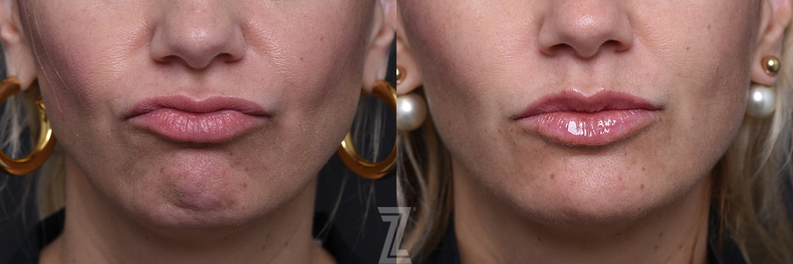 Austin Injectable Fillers Before & After Gallery - Patient 219526 - Image 6 - The Piazza Center