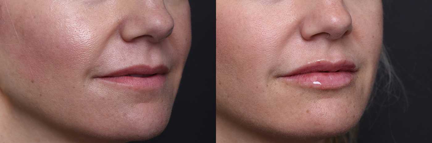 Austin Injectable Fillers Before & After Gallery - Patient 219526 - Image 4 - The Piazza Center