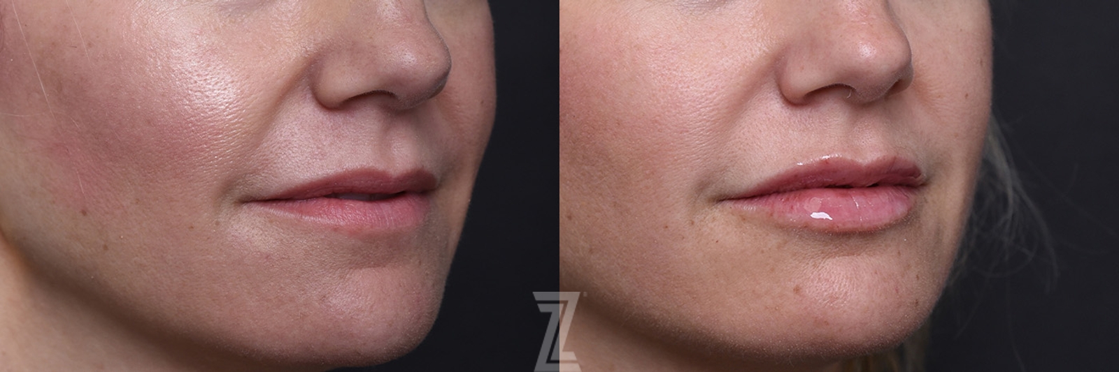 Austin Injectable Fillers Before & After Gallery - Patient 219526 - Image 4 - The Piazza Center