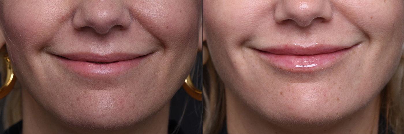Austin Injectable Fillers Before & After Gallery - Patient 219526 - Image 5 - The Piazza Center