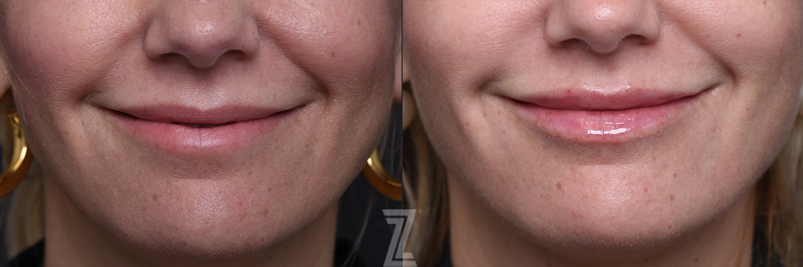 Austin Injectable Fillers Before & After Gallery - Patient 219526 - Image 5 - The Piazza Center