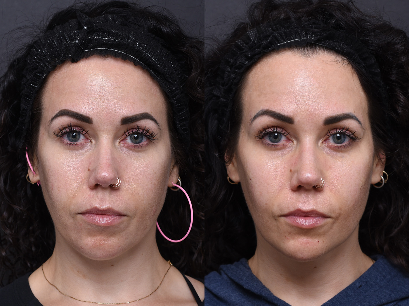 Austin Wrinkle Relaxers Before & After Gallery - Patient 368559 - Image 2 - The Piazza Center