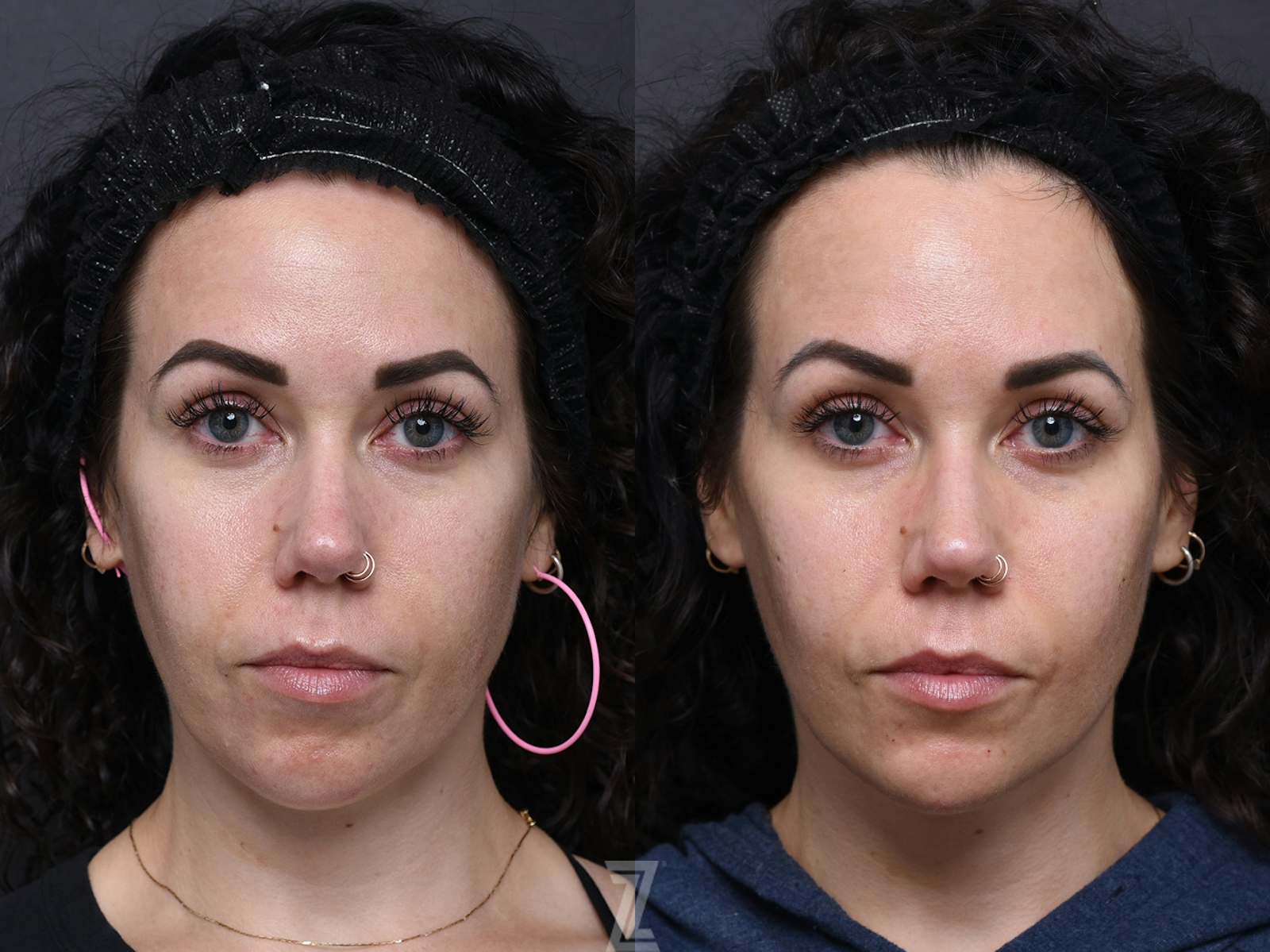 Austin Wrinkle Relaxers Before & After Gallery - Patient 368559 - Image 2 - The Piazza Center