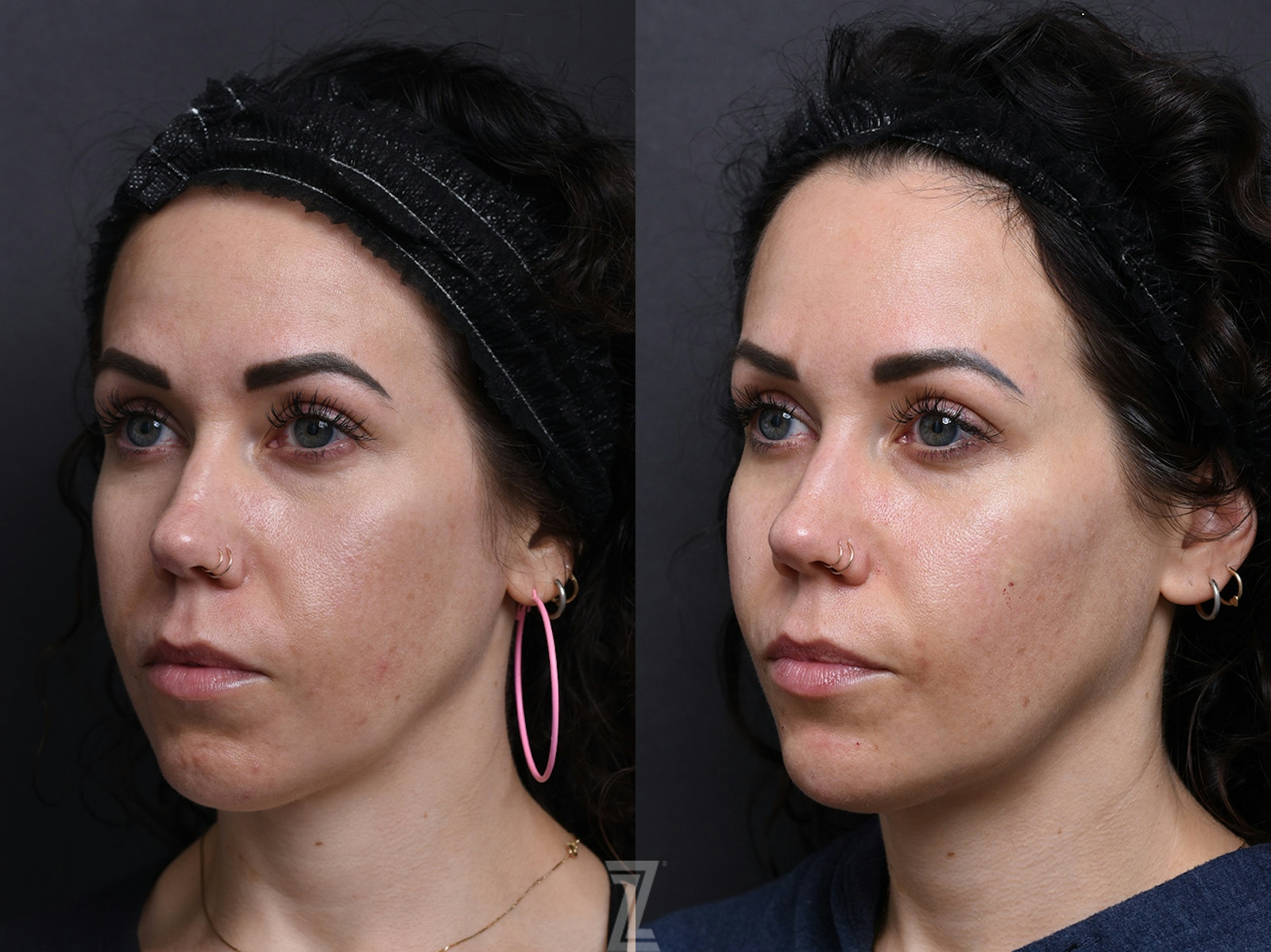 Austin Wrinkle Relaxers Before & After Gallery - Patient 368559 - Image 1 - The Piazza Center