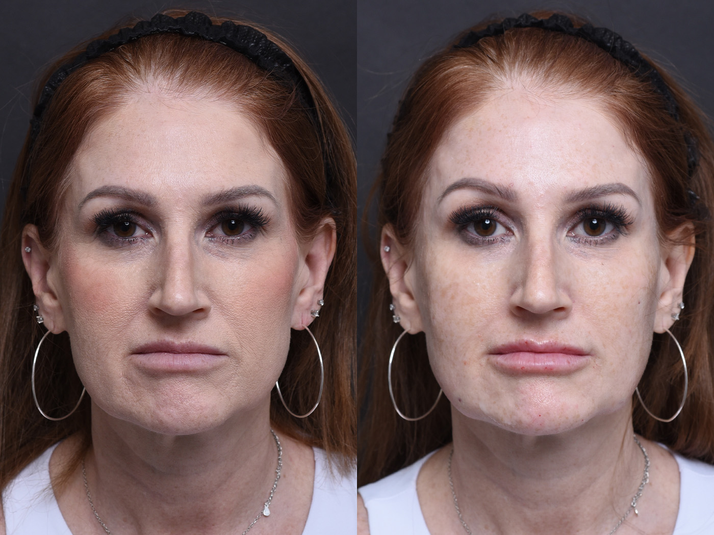 Austin Injectable Fillers Before & After Gallery - Patient 390602 - Image 2 - The Piazza Center