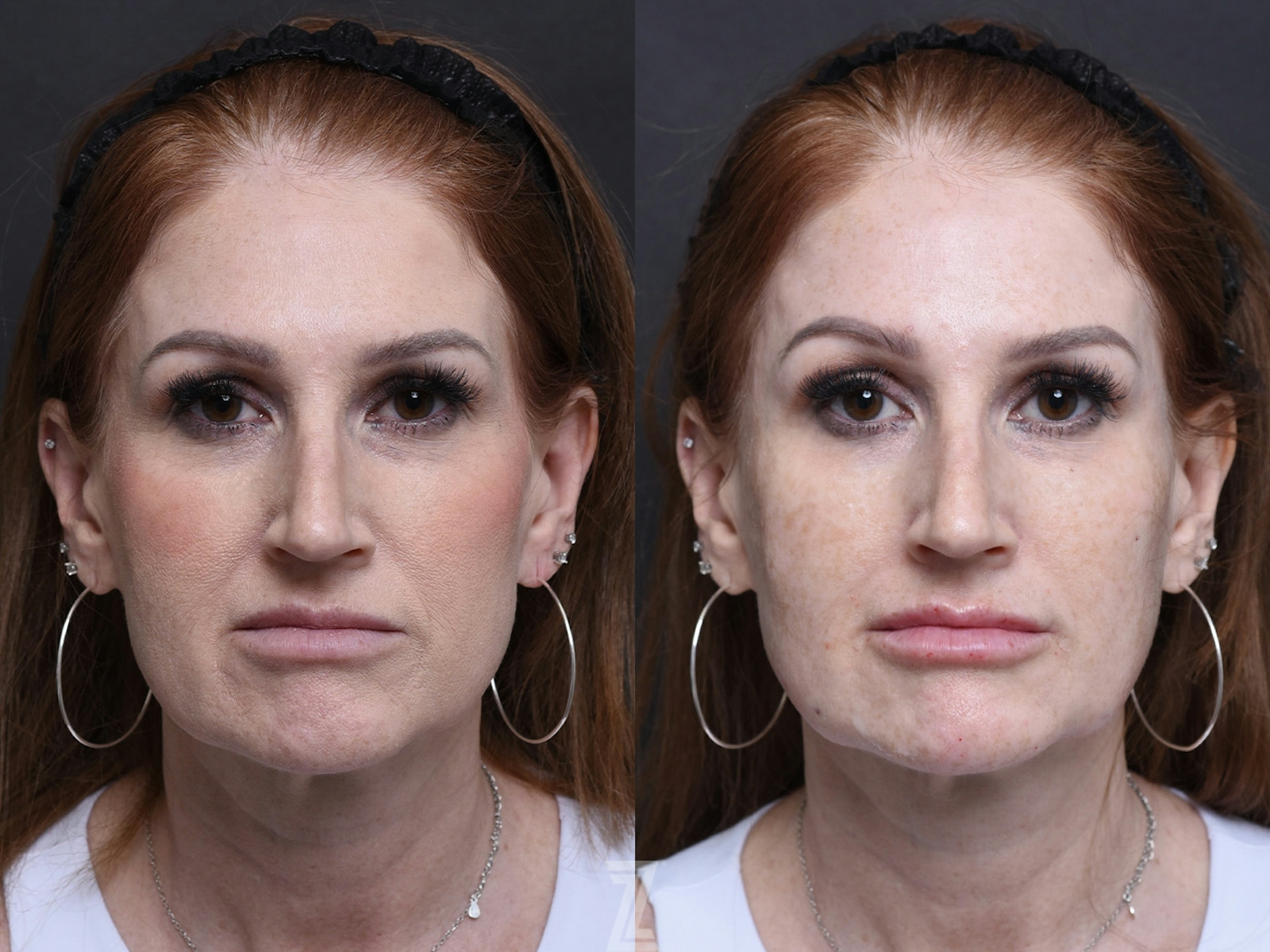 Austin Injectable Fillers Before & After Gallery - Patient 390602 - Image 2 - The Piazza Center