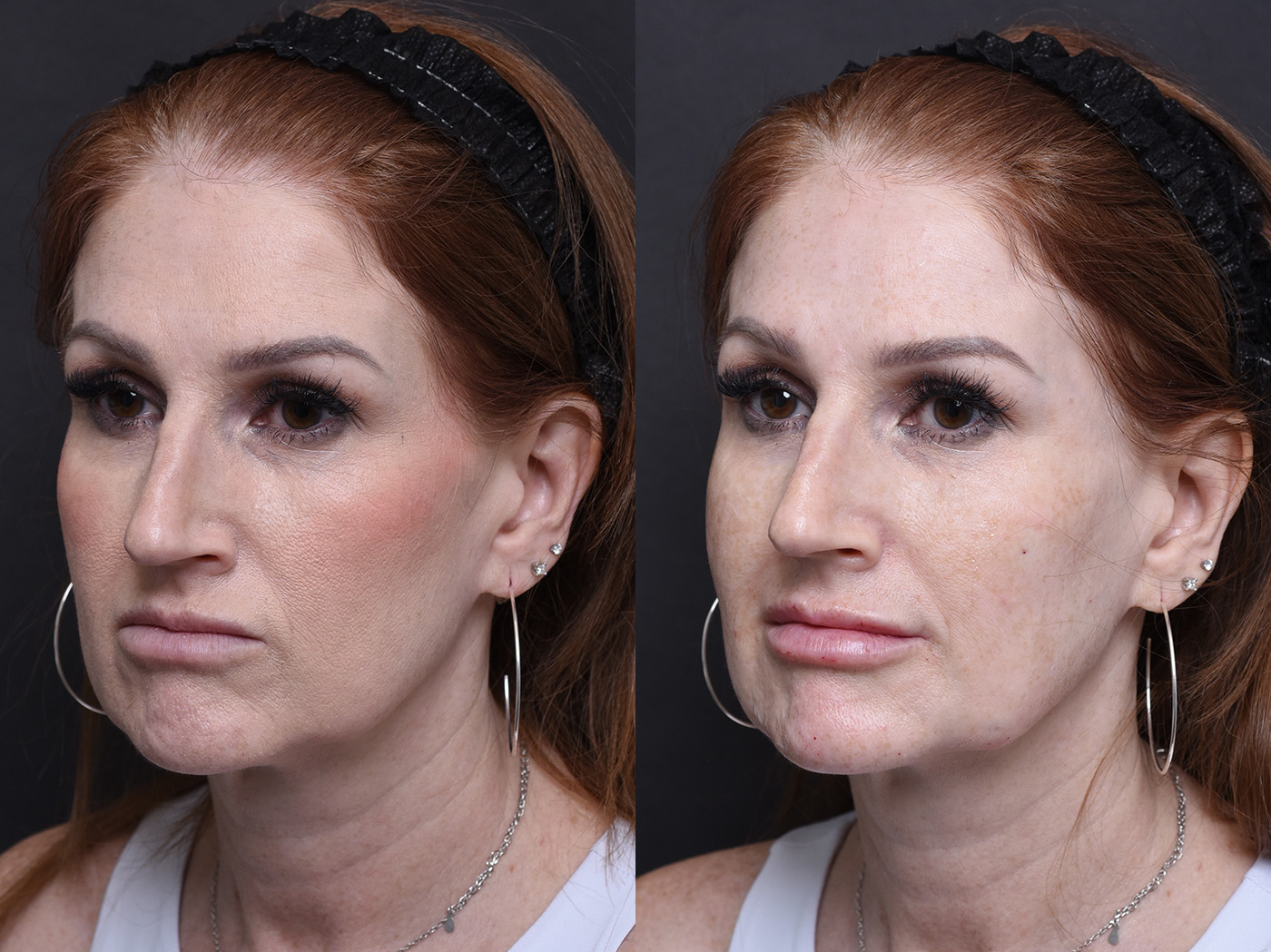 Austin Injectable Fillers Before & After Gallery - Patient 390602 - Image 1 - The Piazza Center
