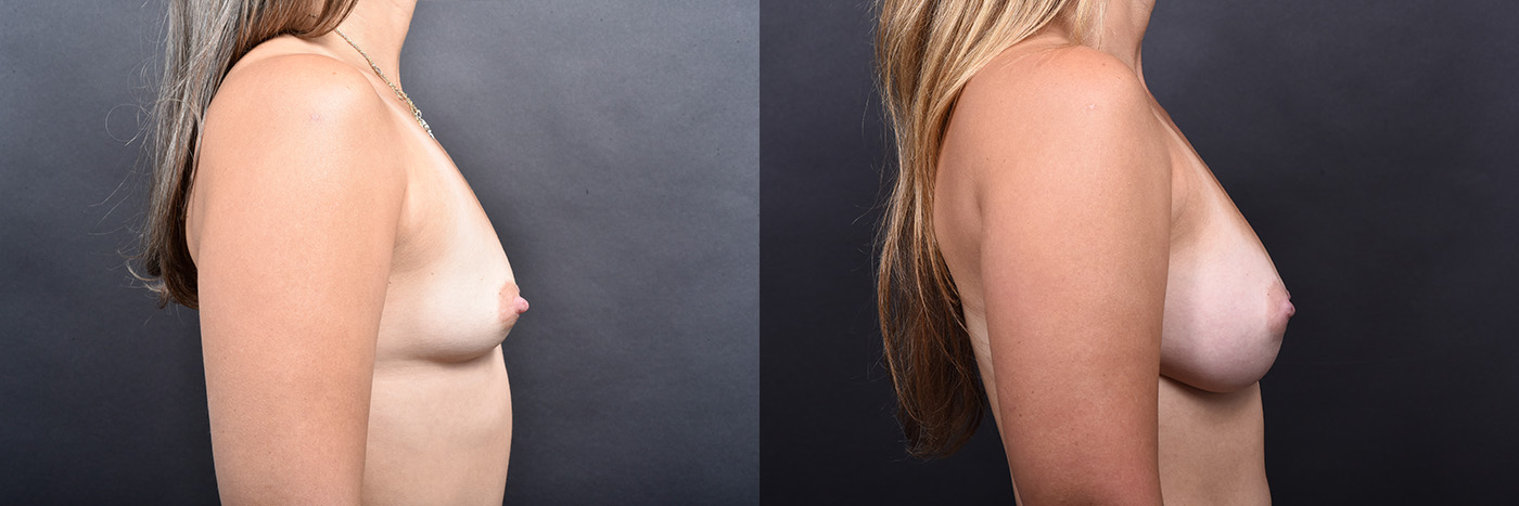 Austin Side View of Breast Augmentation Before & After at The Piazza Center in Austin - Dr. Rocco Piazza - The Piazza Center