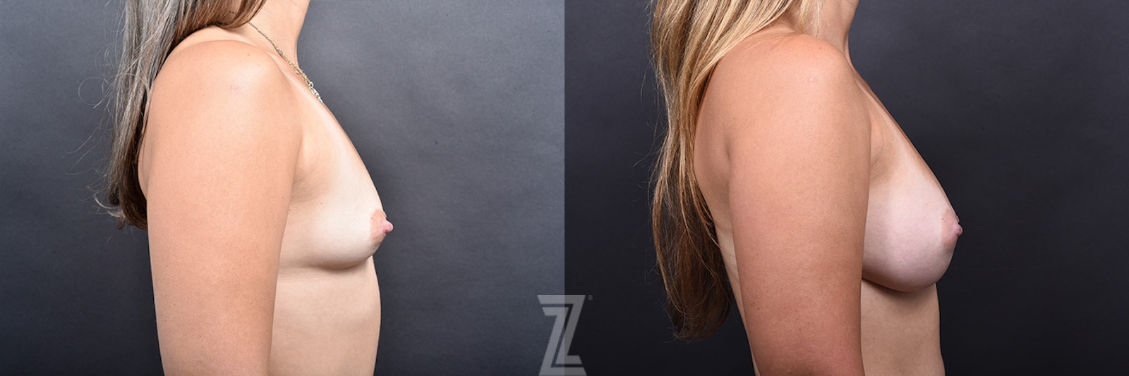Austin Side View of Breast Augmentation Before & After at The Piazza Center in Austin - Dr. Rocco Piazza - The Piazza Center