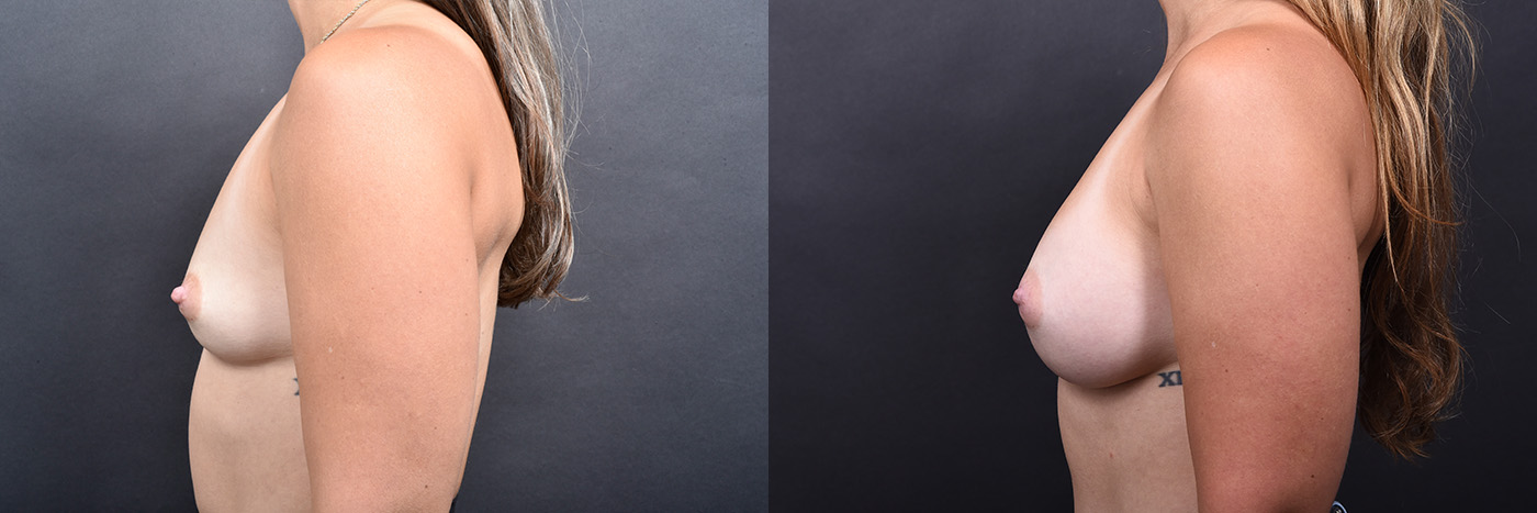 Austin Breast Augmentation Before & After at The Piazza Center in Austin - Dr. Rocco Piazza - The Piazza Center