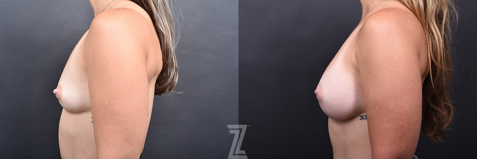 Austin Breast Augmentation Before & After at The Piazza Center in Austin - Dr. Rocco Piazza - The Piazza Center