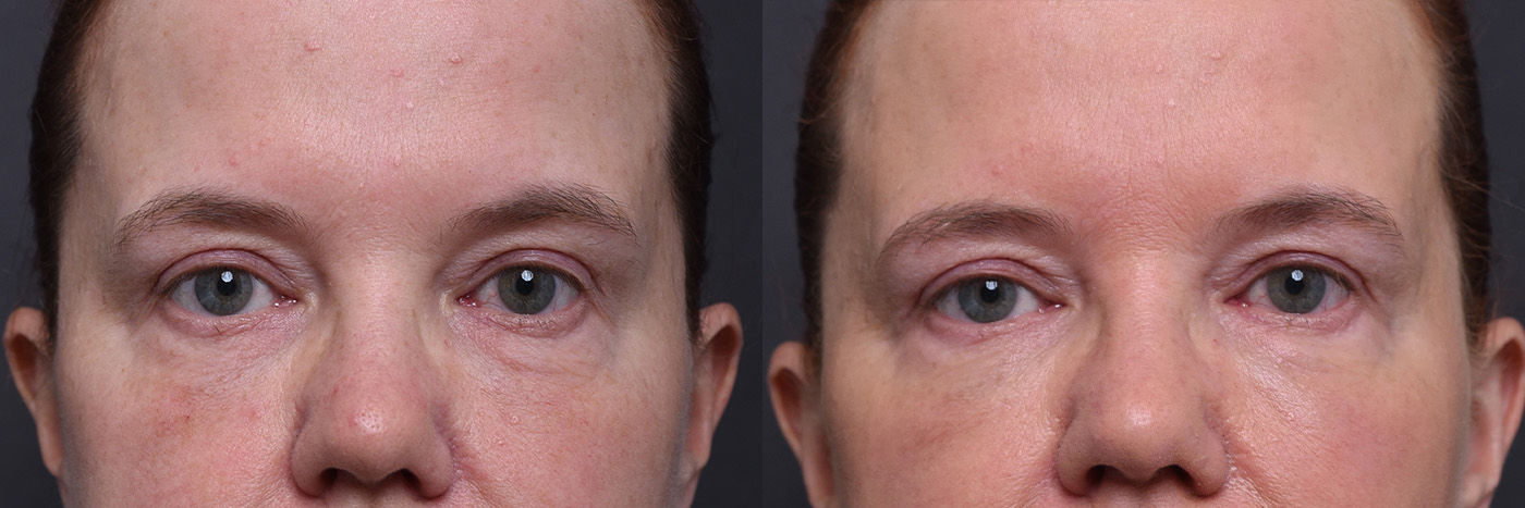 Austin ezGEL Before & After Gallery - Patient 257626 - Image 1 - The Piazza Center