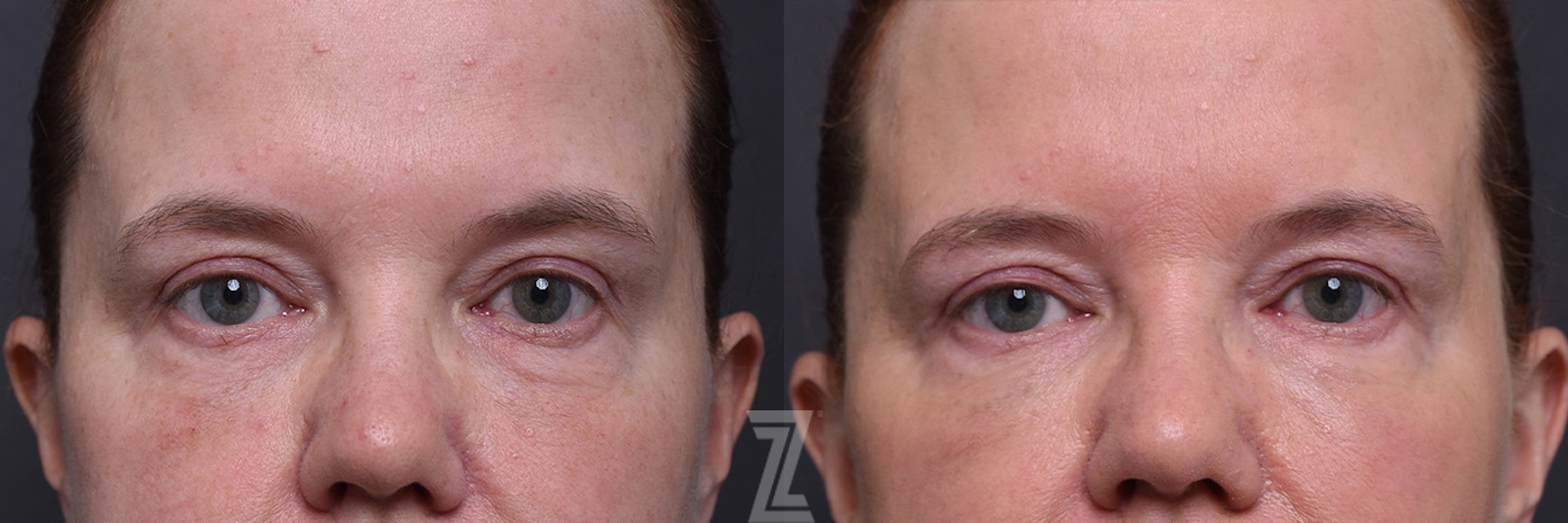 Austin ezGEL Before & After Gallery - Patient 257626 - Image 1 - The Piazza Center