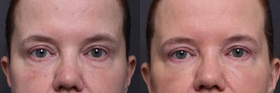 Austin ezGEL Before & After Gallery - Patient 257626 - Image 1 - The Piazza Center