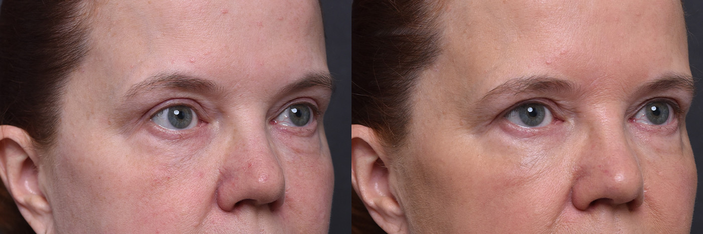 Austin ezGEL Before & After Gallery - Patient 257626 - Image 2 - The Piazza Center