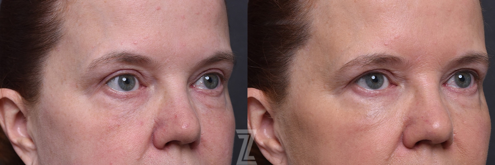 Austin ezGEL Before & After Gallery - Patient 257626 - Image 2 - The Piazza Center