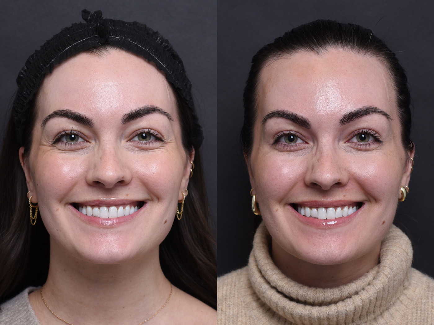 Austin Wrinkle Relaxers Before & After Gallery - Patient 142934 - Image 1 - The Piazza Center