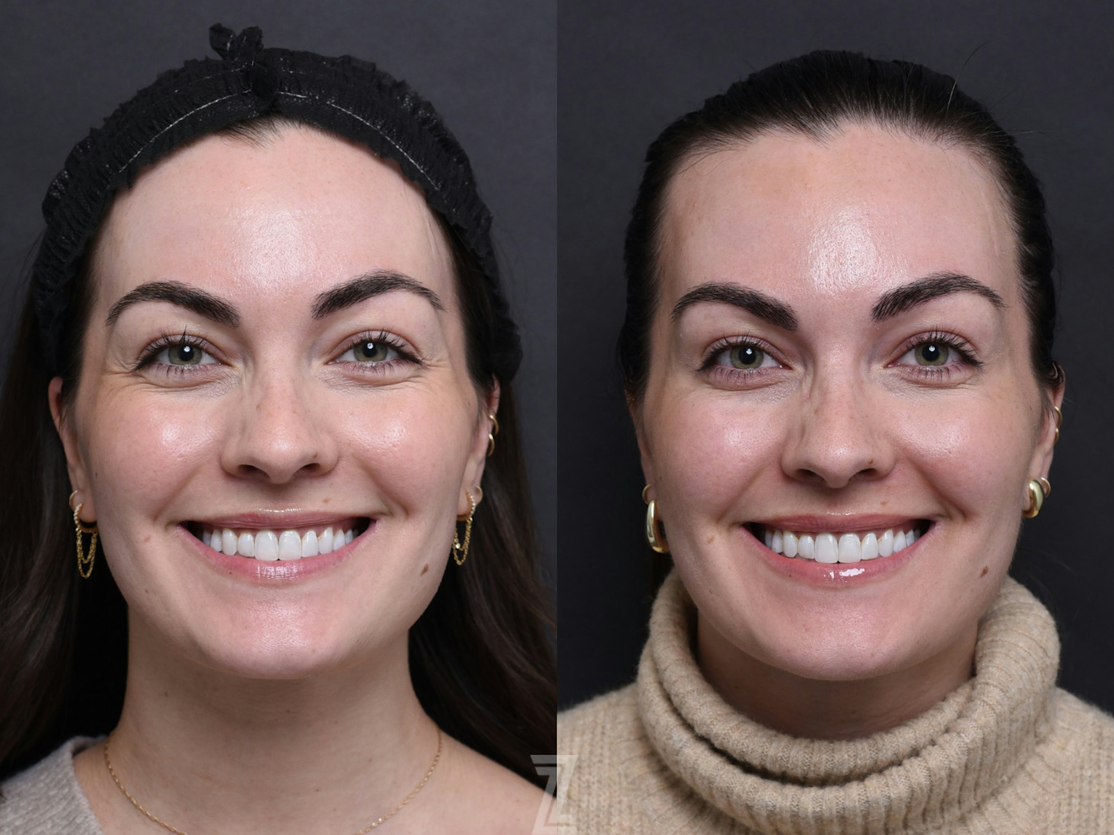 Austin Wrinkle Relaxers Before & After Gallery - Patient 142934 - Image 1 - The Piazza Center