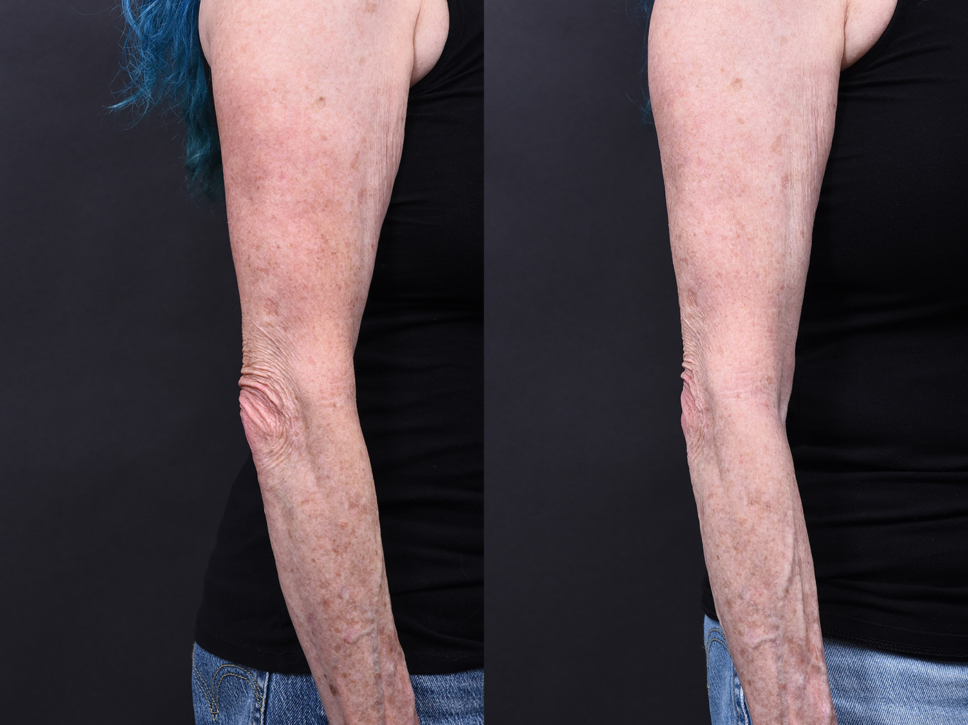 Austin BBL Before & After Gallery - Patient 344560 - Image 1 - The Piazza Center