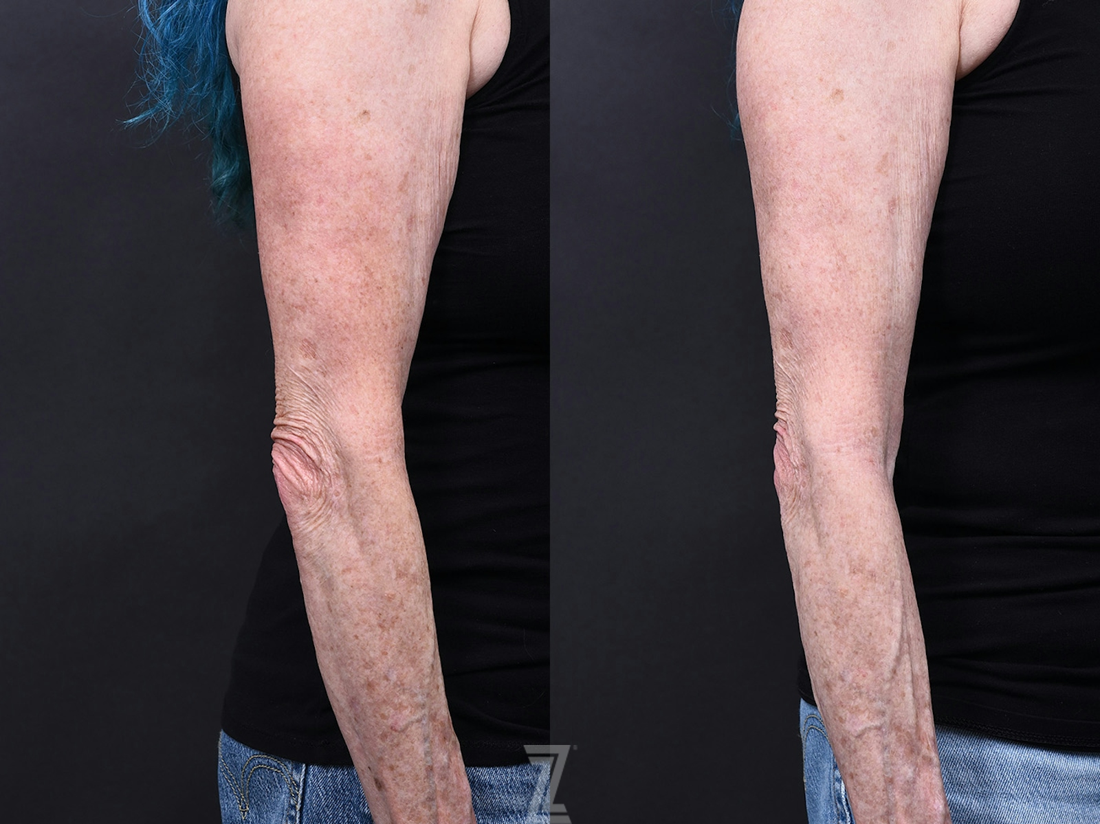 Austin BBL Before & After Gallery - Patient 344560 - Image 1 - The Piazza Center