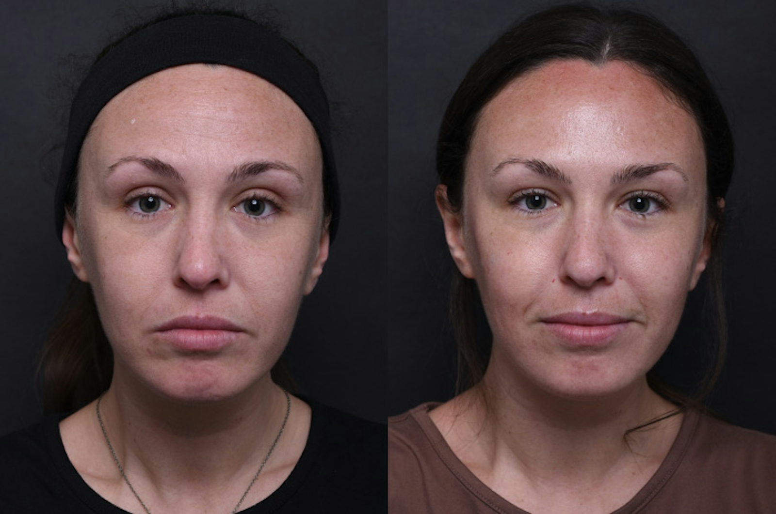 Austin Injectable Fillers Before & After Gallery - Patient 242235 - Image 1 - The Piazza Center