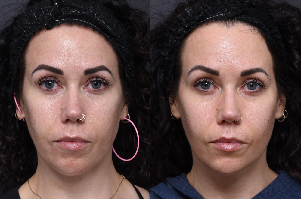 Austin Injectable Fillers Before & After Gallery - Patient 176895 - Image 1 - The Piazza Center