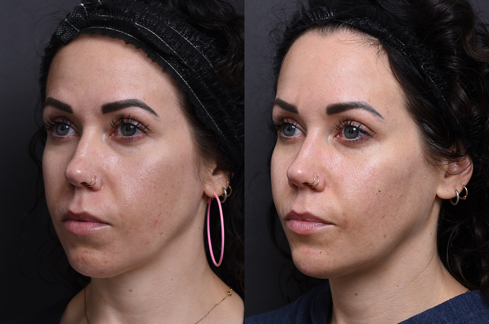 Austin Injectable Fillers Before & After Gallery - Patient 176895 - Image 2 - The Piazza Center