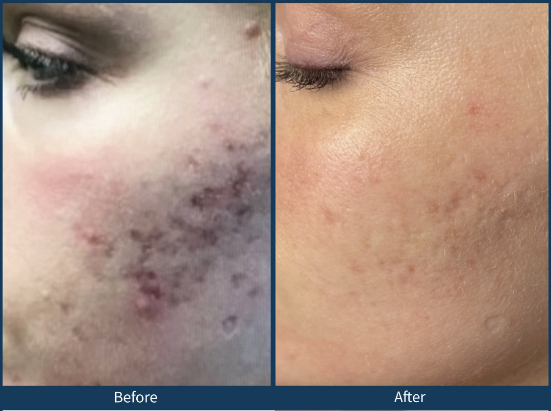 Microneedling Before and After in Austin, TX