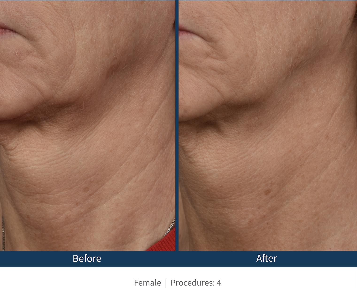 Wrinkles before and after microneedling