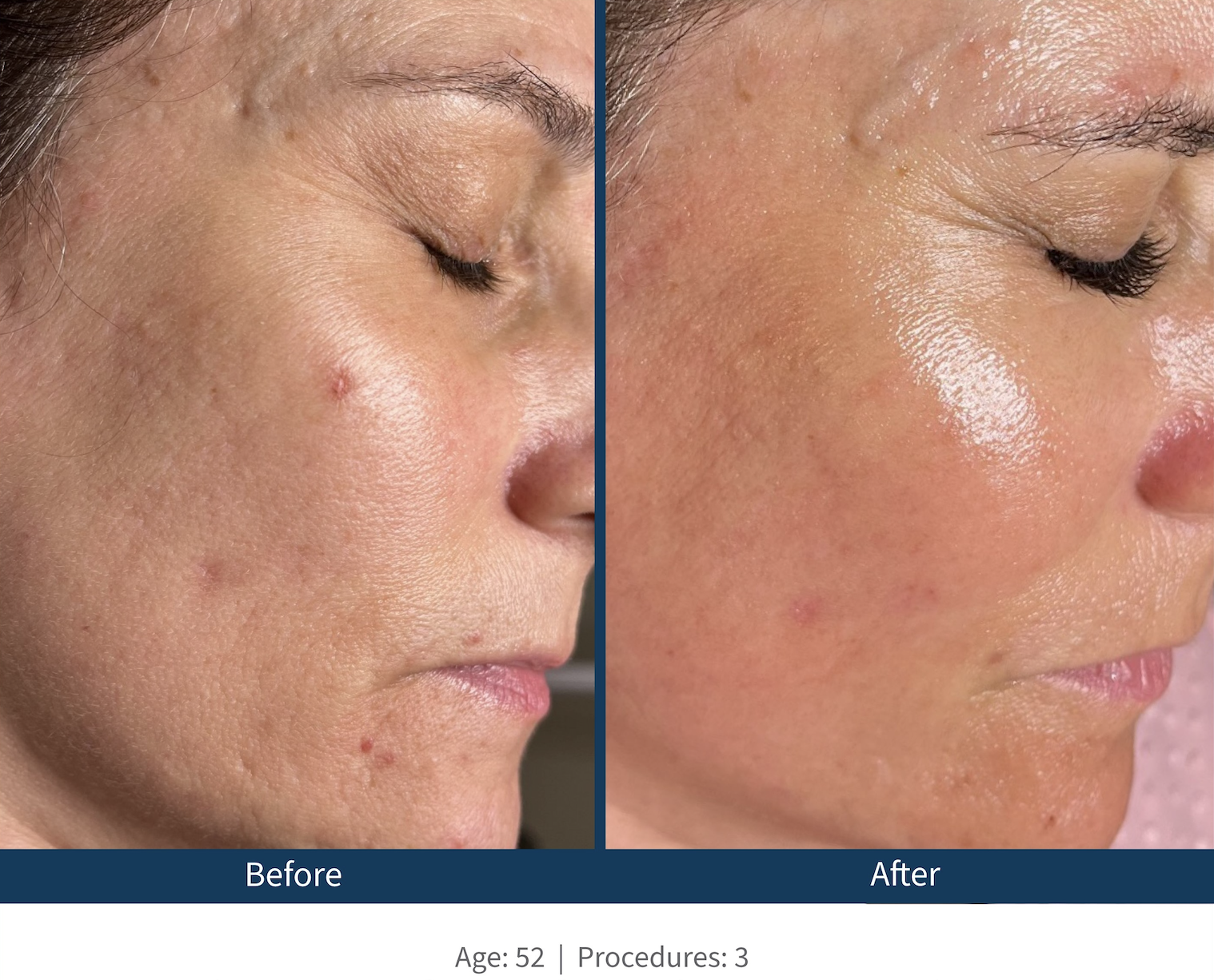 Texture + Pore Size after Microneedling Austin TX