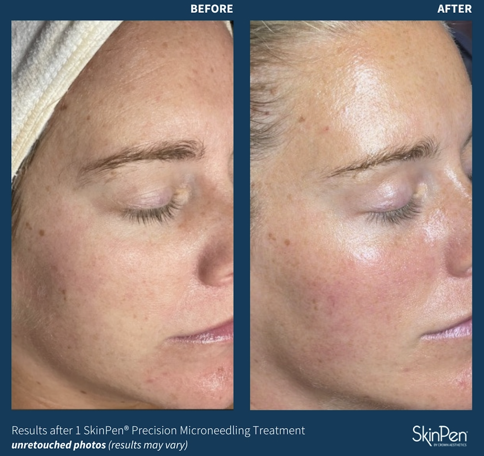Sun Damage Before and After with Microneedling