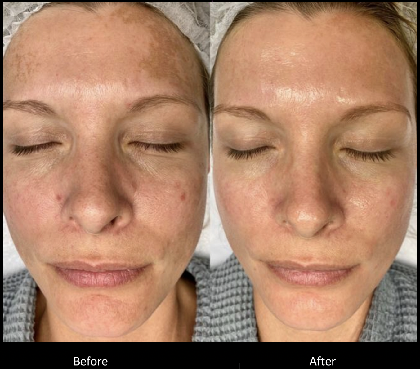 Melasma before and after moxi