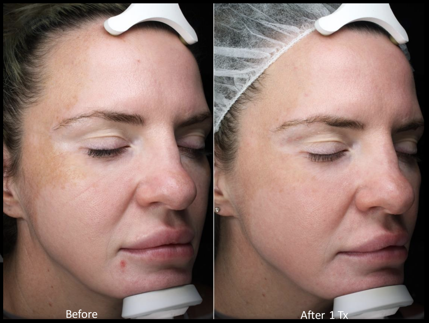 MOXI for Melasma