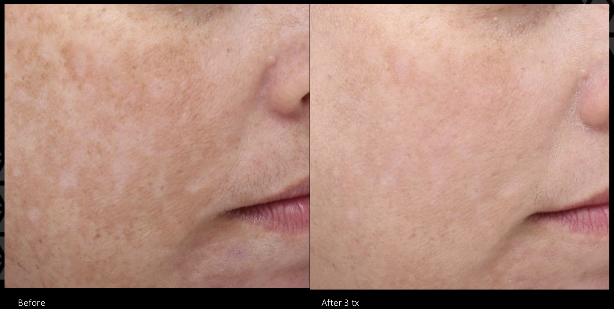 Melasma treatment with MOXI laser