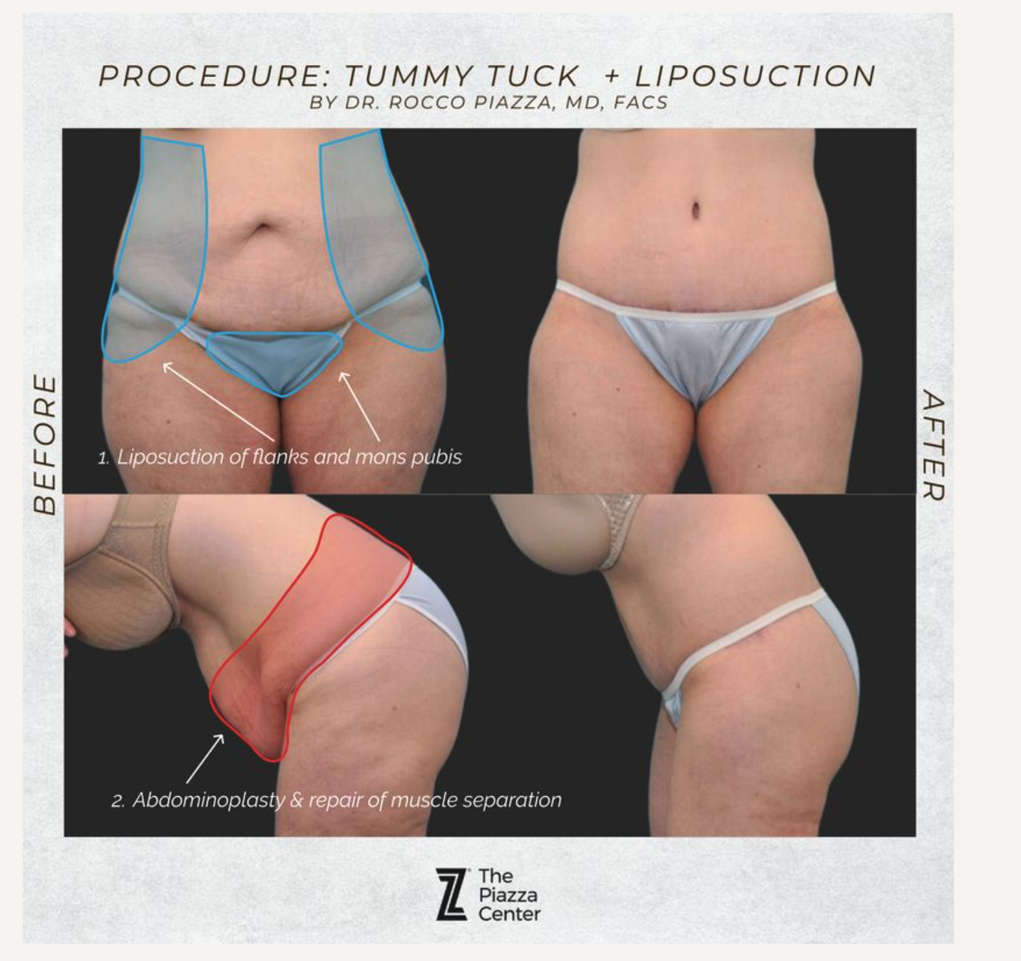Tummy tuck area of focus infographic