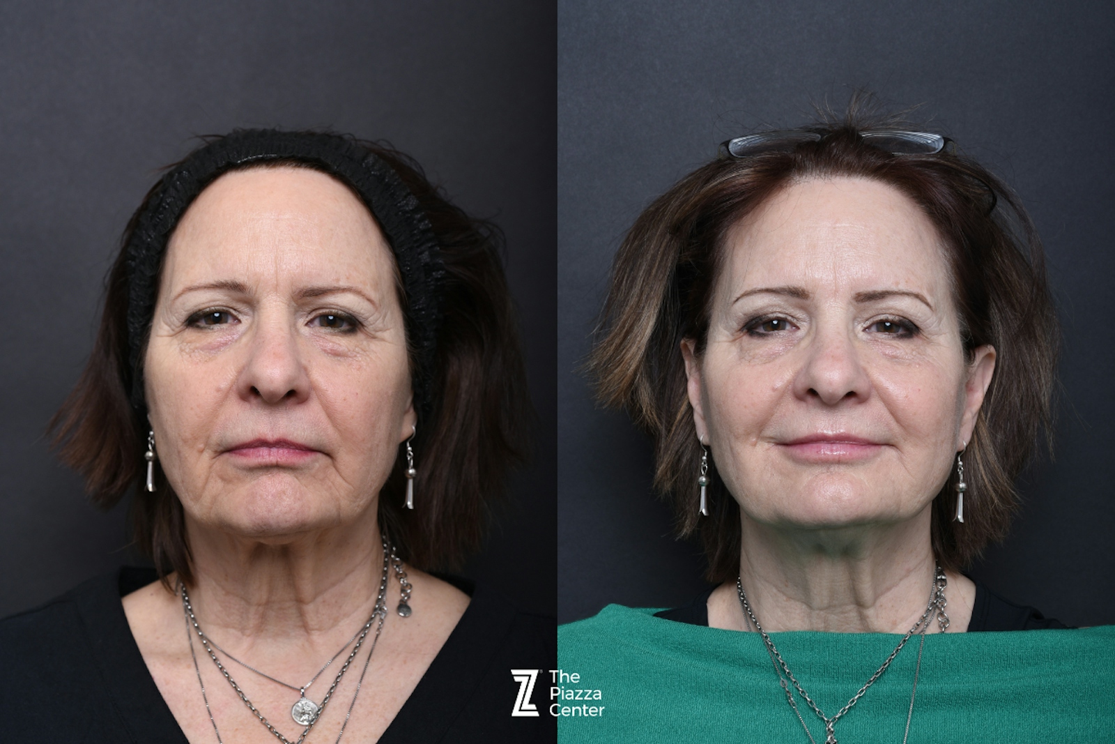 Austin Injectable Fillers Before & After Gallery - Patient 284343 - Image 1 - The Piazza Center