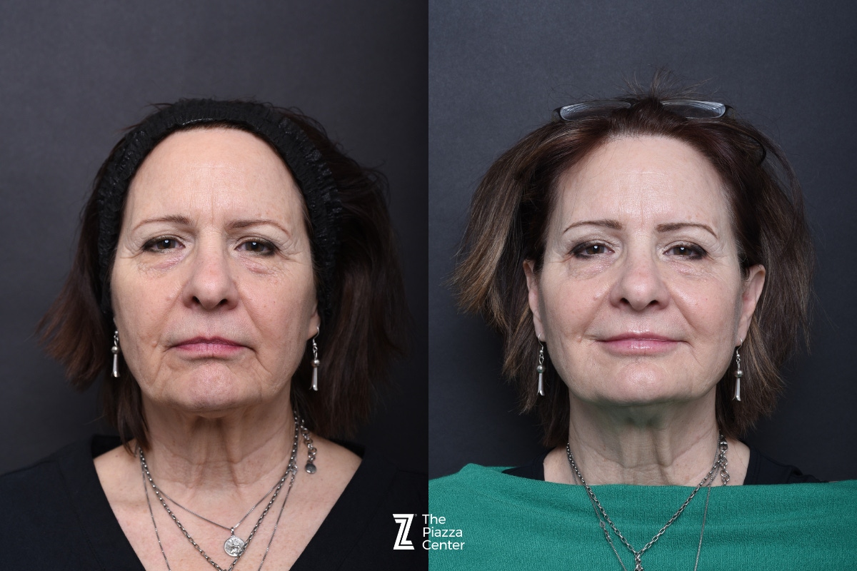Austin Injectable Fillers Before & After Gallery - Patient 284343 - Image 1 - The Piazza Center