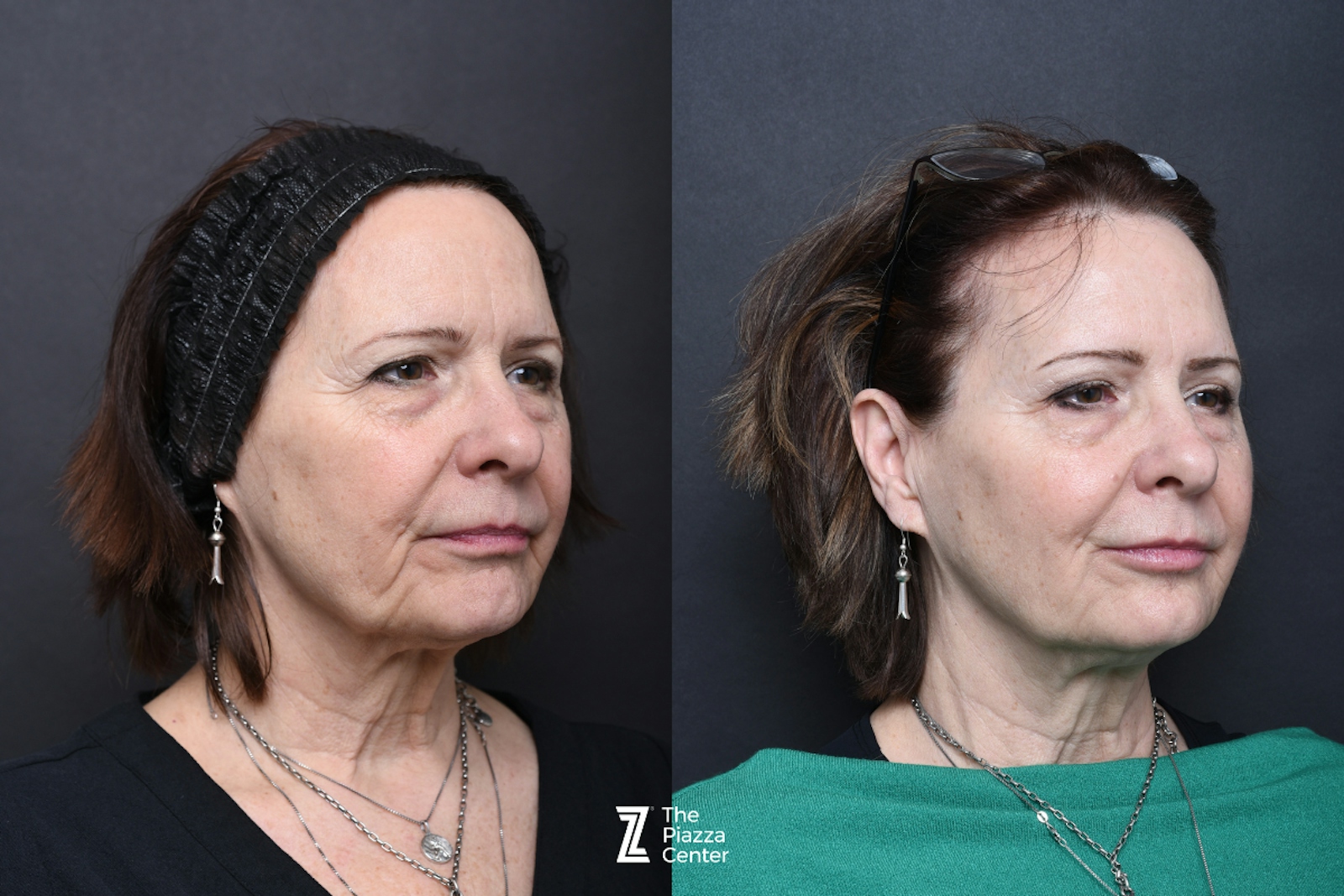Austin Injectable Fillers Before & After Gallery - Patient 284343 - Image 2 - The Piazza Center