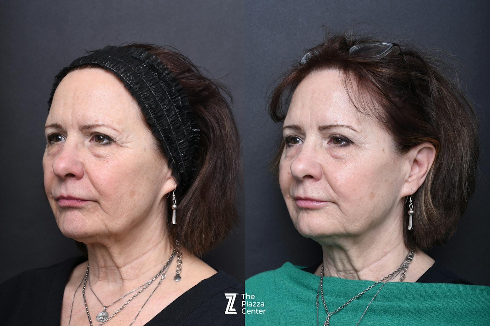 Austin Injectable Fillers Before & After Gallery - Patient 284343 - Image 3 - The Piazza Center