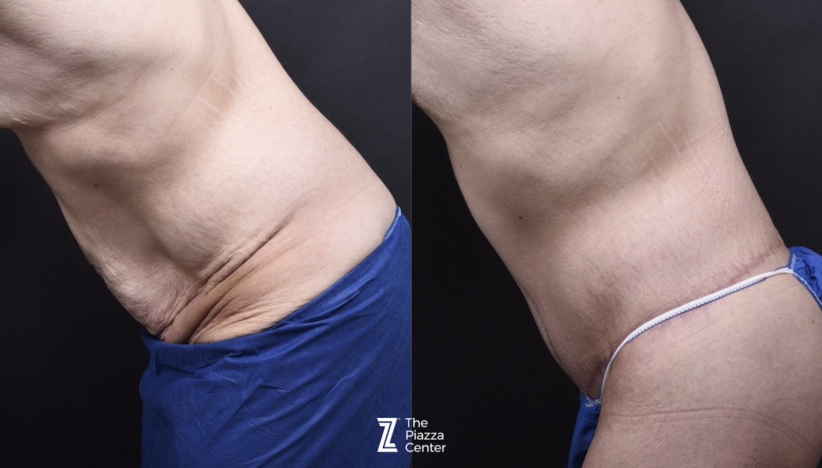 Austin Liposuction Before & After Gallery - Patient 313599 - Image 5 - The Piazza Center