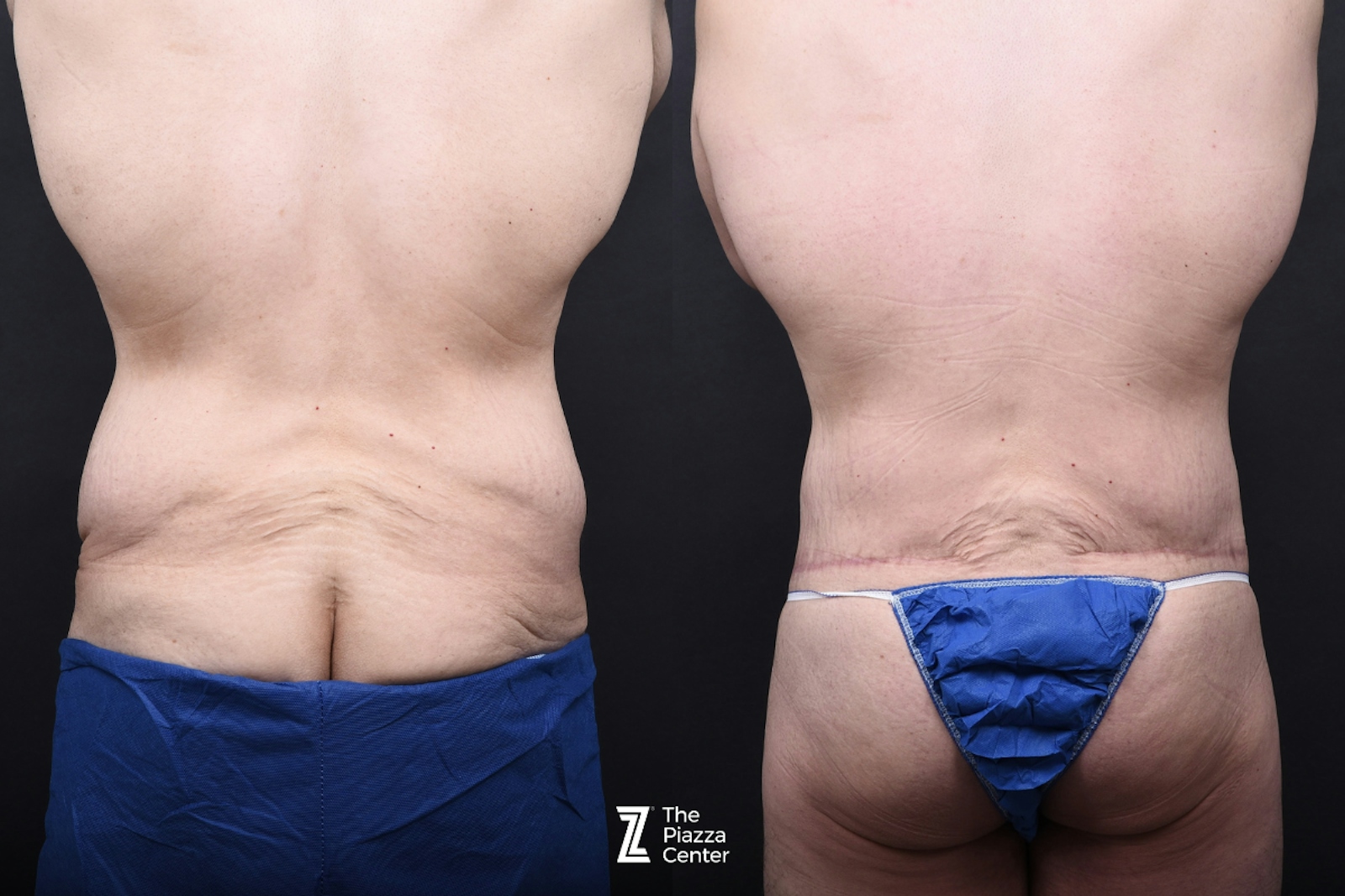 Austin Liposuction Before & After Gallery - Patient 313599 - Image 6 - The Piazza Center