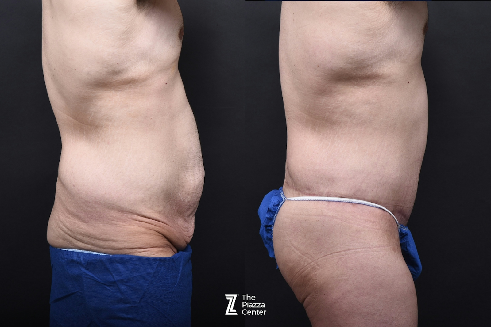 Austin Liposuction Before & After Gallery - Patient 313599 - Image 2 - The Piazza Center