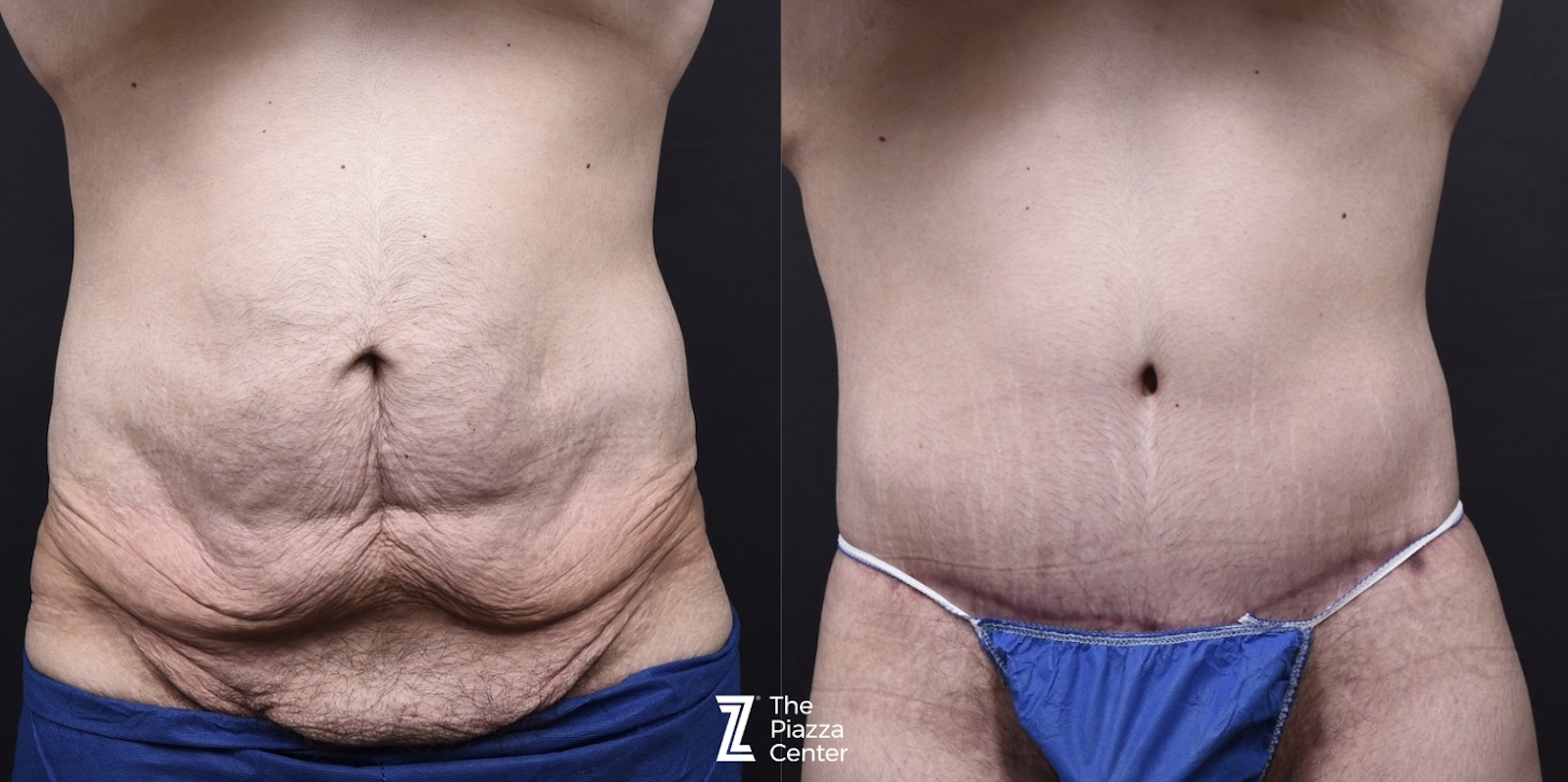 Austin Liposuction Before & After Gallery - Patient 313599 - Image 1 - The Piazza Center