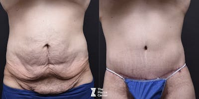 Austin Liposuction Before & After Gallery - Patient 313599 - Image 1 - The Piazza Center